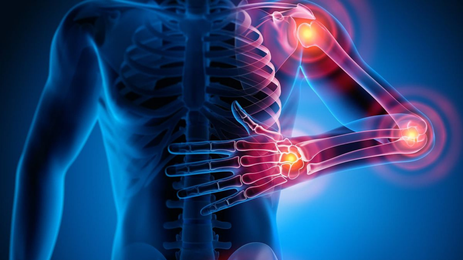 Arthritis Management